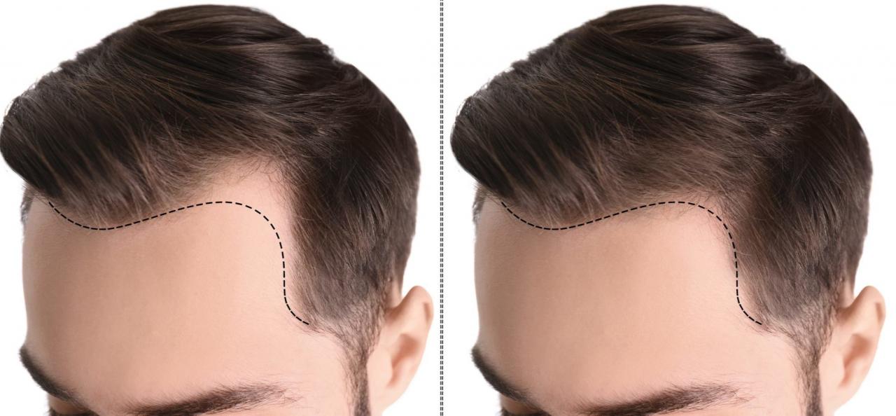 تجربتي في زراعة الشعر للنساء - مشكلات الفراغات