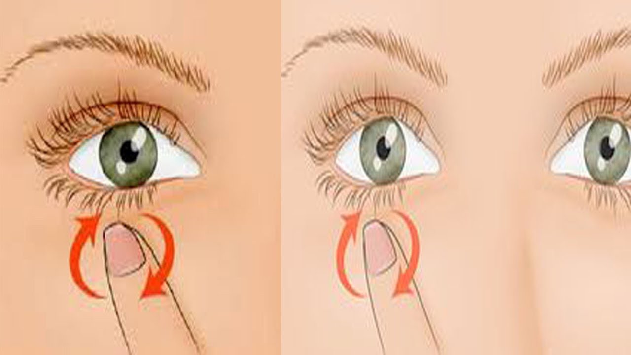 اسباب واعراض رفرفة العين , سبب ثقل العين