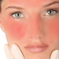 826 1 طرق علاج حروق الوجه - علاج البشرة نهاد